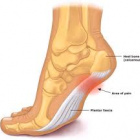 Plantar Fasciitis